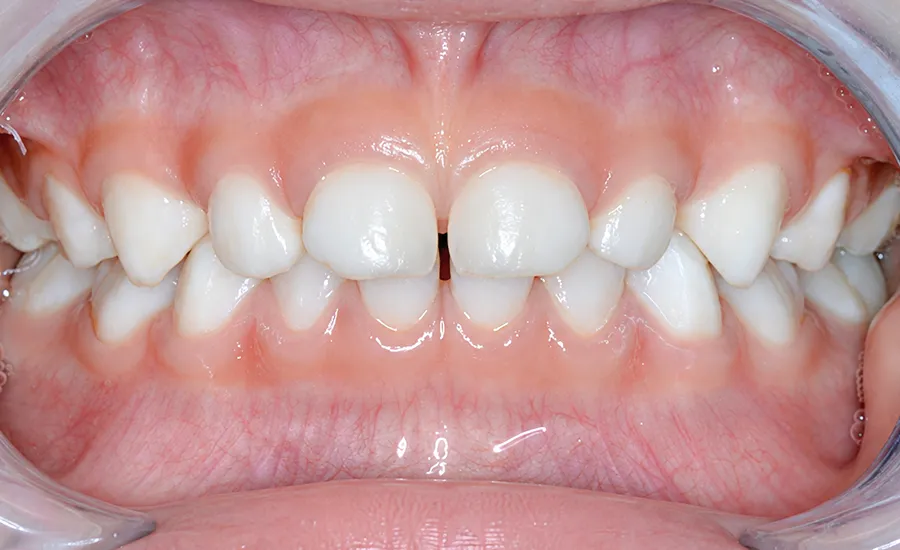 Straight teeth at age four