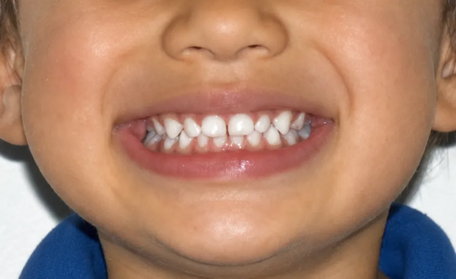 Straight teeth at age four