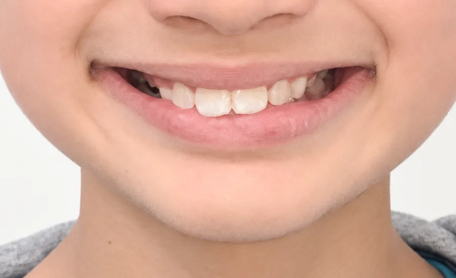 bite changed over time