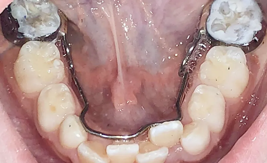Comprehensive lower braces