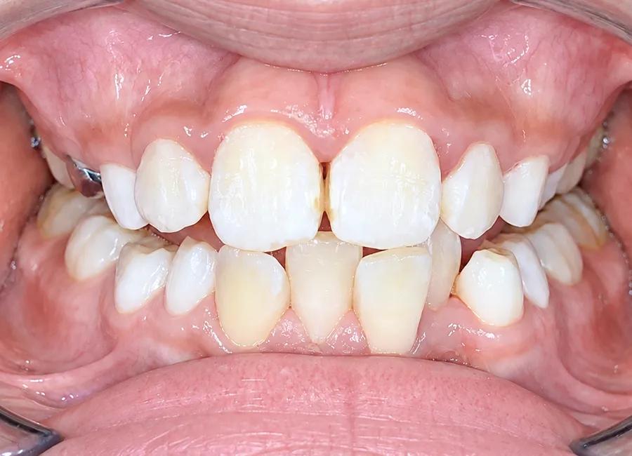 Bite Correction