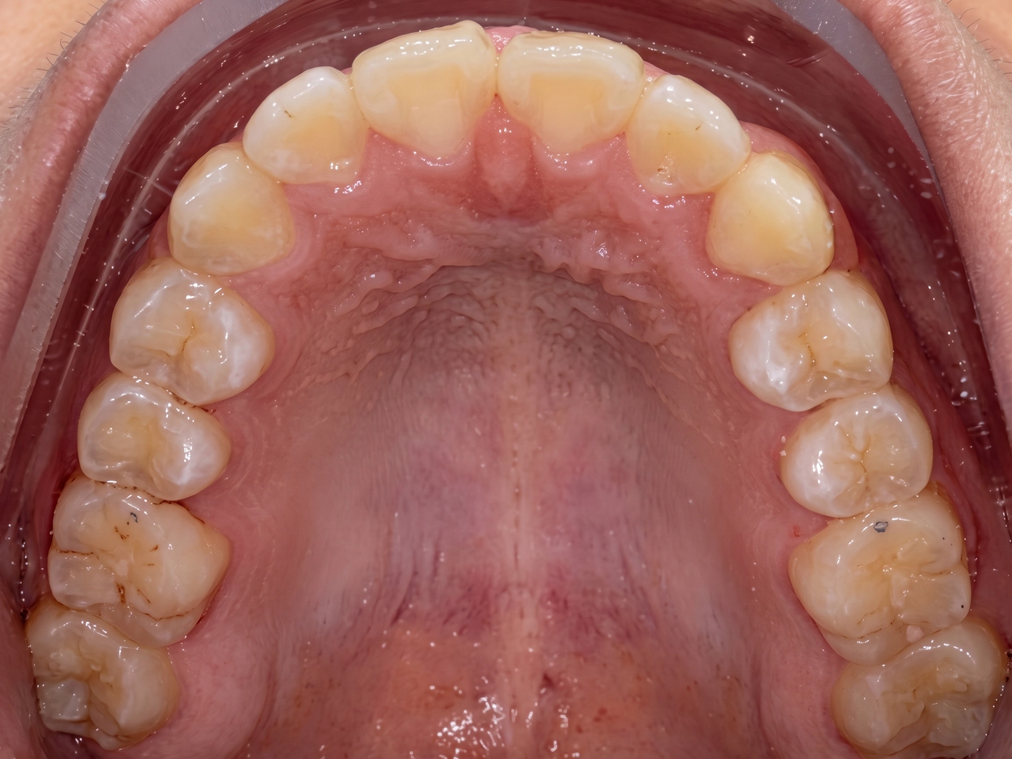 Case Study: Teen Orthodontic Treatment