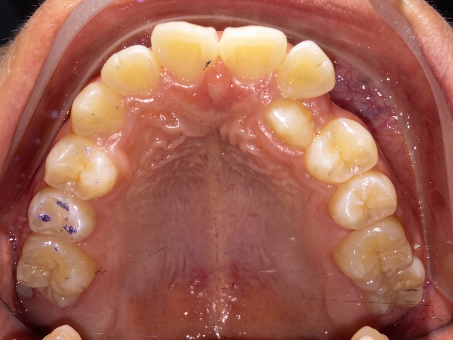 Case Study: Teen Orthodontic Treatment